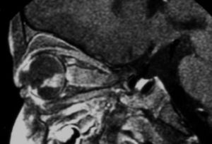 시신경 침범 망막모세포종의 MRI 패턴(시상 강화 T1 강조 시퀀스)