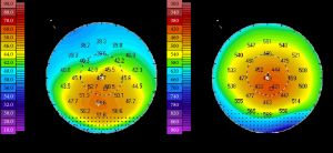 각막 지형도에서 보여지는 2단계 원추각막