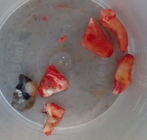 수술적 발치 중 절단된 어금니 - 세 개의 뿌리의 곡선(오른쪽 위)은 단순 발치를 방해함