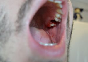 사랑니 발치 후 한 시간