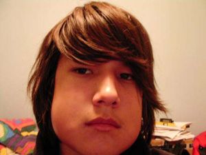 제3대구치(사랑니) 발치 후 부종의 예시