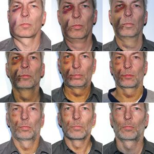 시간 경과에 따른 부종 및 멍의 회복