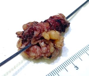 이전 위루술의 결과로 발생한 외과적으로 절제된 위피부 누공 경로