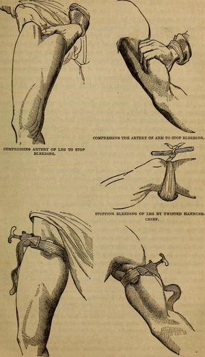 출혈을 멈추기 위해 사용된 손수건