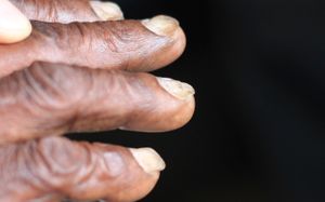 함입손톱(숟가락 모양의 손톱)