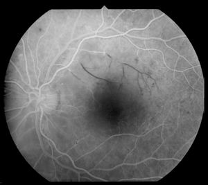 당뇨병성 망막병증 환자에서 동맥 가지가 폐색되면서 망막세정맥이 비어버린 모습 (플루오레세인 혈관조영술)
