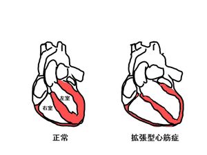 확장성 심근병증으로 인해 확장된 심장