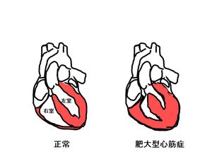 비대성 심근병증의 심장 단면