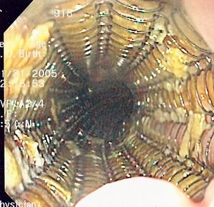 내시경 사진, 자가 팽창형 금속 스텐트가 식도에 삽입되어 식도암을 완화 치료