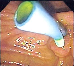 십이지장 내시경 검사 시 바터 팽대부에서 튀어나온 담도 스텐트의 내시경 이미지