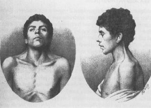 누난 증후군의 가장 오래된 사례 (1883년 Kobylinski 기술)