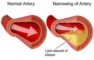 지질 축적이 동맥 협착 부위 아래 혈류를 막는 방식을 보여주는 그림