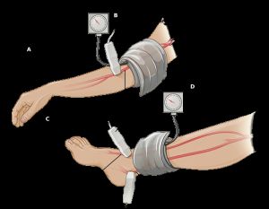 발목-상완 지수를 보여준다. (참고: 맥박의 초음파 증강은 필수는 아니지만 도움이 될 수 있다.)