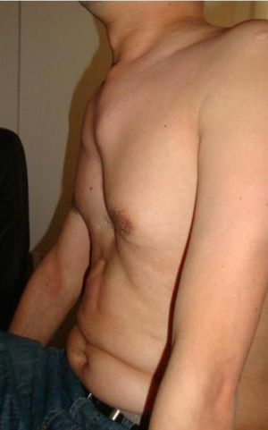 마르판 증후군 환자의 앞쪽 가슴 벽 기형인 오목 가슴