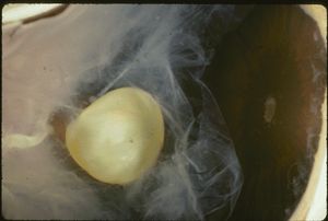 수정체 탈구는 수정체가 콩팥 모양을 하고 모양체에 닿아있는 마르판 증후군에서 발생한다.