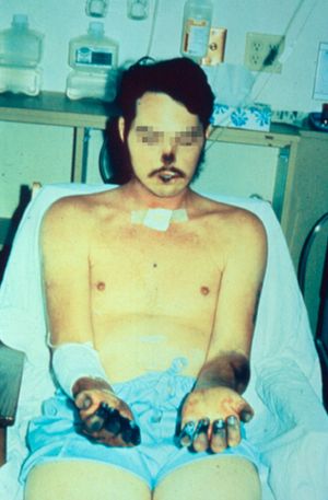 괴사 (Necrosis)로 인해 코, 입술, 손가락이 검게 변하고, 혈액과 폐로 전파된 흑사병에서 회복 중인 사람의 양쪽 팔뚝에 멍이 남은 모습. 한때 이 사람의 온몸에 멍이 있었다.