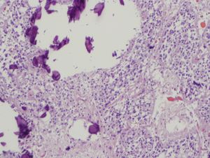 송과선 실질과 석회화
