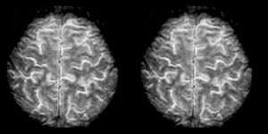 인간 뇌의 고해상도 fMRI
