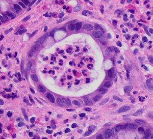 샘 곪음. H&E 염색.