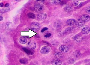신경내분비 종양의 유사분열.