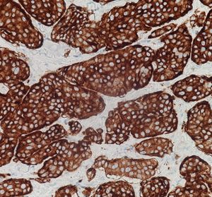 시냅토피신 면역조직화학 염색으로 신경내분비 종양을 양성으로 염색함