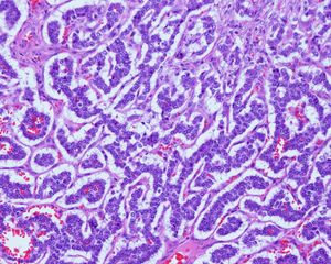 췌장 신경내분비 종양의 H&E 염색상.