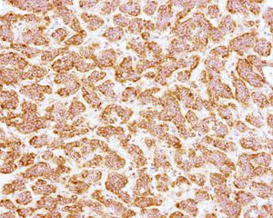 췌장 신경내분비 종양의 시냅토피신(Synaptophysin) 면역 염색(IHC) 결과.