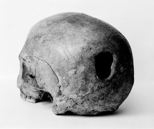 에든버러에서 발견된 절개된 두개골