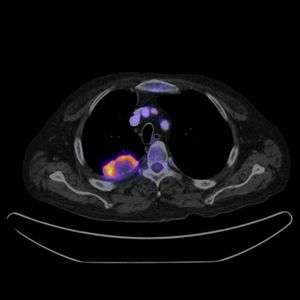 가슴 PET-CT 스캔