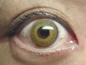 컬러 콘택트 렌즈 착용 예