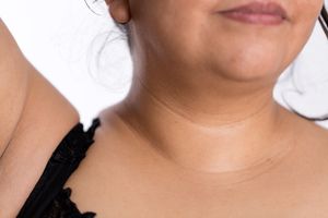 monillas}}) 또는 "달 고리"의 발달.