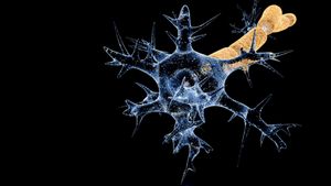 길랭-바레 증후군 – 탈수초화