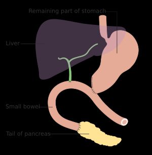 휘플 수술 후 췌장과 장을 다시 연결하는 방법