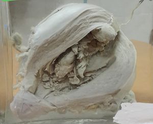 폴립형 자궁내막 선암종