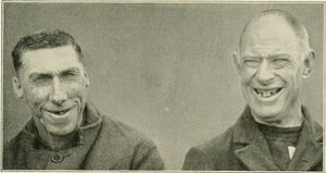 소두증(왼쪽)과 정상두증(오른쪽)