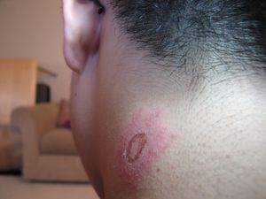 부상당한 페인트볼 선수