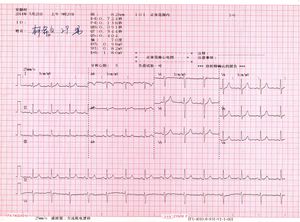 정상 12 유도 심전도