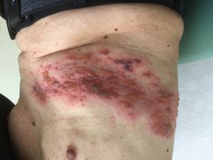 대상포진 84세 남성 3일째