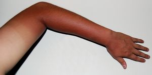 햇볕에 노출되어 피부가 더 어둡게 변한 선탠된 팔. 이러한 선탠 패턴은 종종 농부의 선탠이라고 불린다.