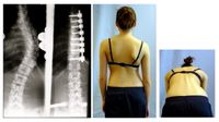 척추측만증 수술에 의한 교정 예시