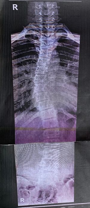 서 있을 때 척추이다. 중력 영향을 받아 척추가 누워 있을 때 보다 매우 크게 휘어졌다. 