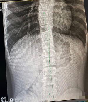 누워 있을 때의 척추이다. 중력 영향을 받지 않아 눈에 띄게 만곡이 줄었다. 