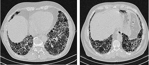 특발성 폐섬유증 환자의 흉부 고해상도 컴퓨터 단층 촬영 스캔. 주요 특징은 벌집 폐를 동반한 주변부, 주로 기저부 패턴의 굵은 망상 구조이다.