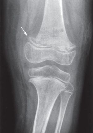 무릎 관절의 엑스레이. 화살표는 괴혈병으로 인해 나타날 수 있는 변화(괴혈병 선)를 가리킨다.