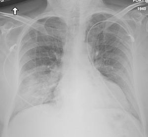 메르스 환자의 흉부 엑스선 사진