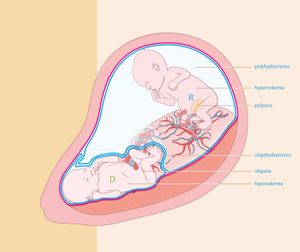 쌍태아 수혈 증후군(TTTS) 그림. 한 태아는 양수가 많아 보이고 다른 태아는 양막에 의해 몸이 압박된 모습이다.