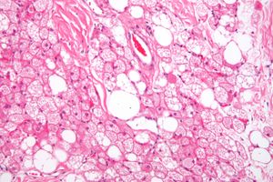 현미경 사진의 겨울잠종. 양성 종양의 일종인 겨울잠종은 갈색 지방에서 발생하는 것으로 알려져 있다. (헤마톡실린과 에오신 염색)