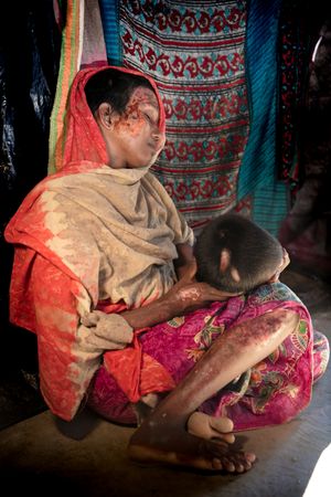 멍과 화상을 입은 로힝야족 여성. 타트마도 병력이 그녀를 집으로 끌고가 강간하고, 그녀를 안에 가둔 채 집을 불태우려 시도했다.