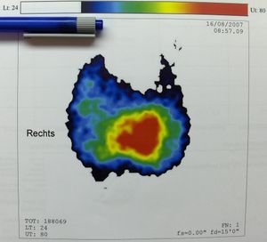 독성 선종이 있는 갑상선종