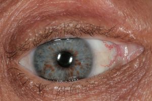 리쉬 결절 - NF1에서 관찰됨